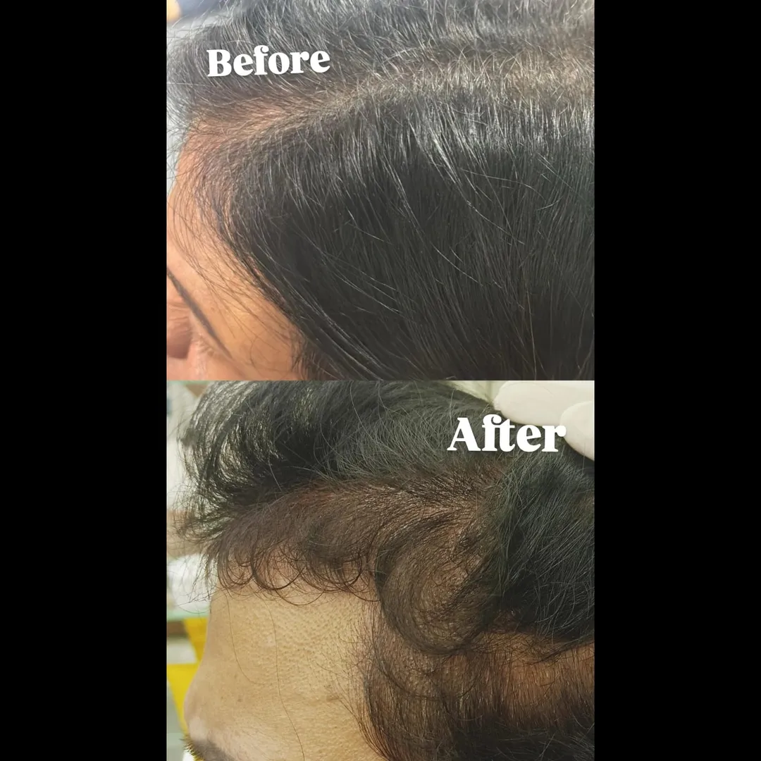 Hair Prp Treatment In Vashi