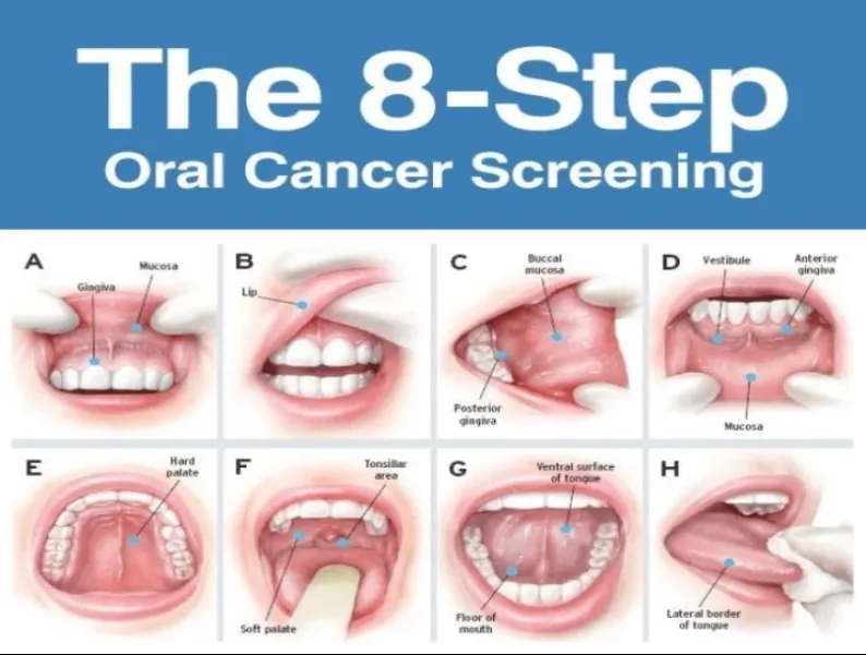 Oral Cancer Detection in Greater Noida West | P.D. Dental Clinic