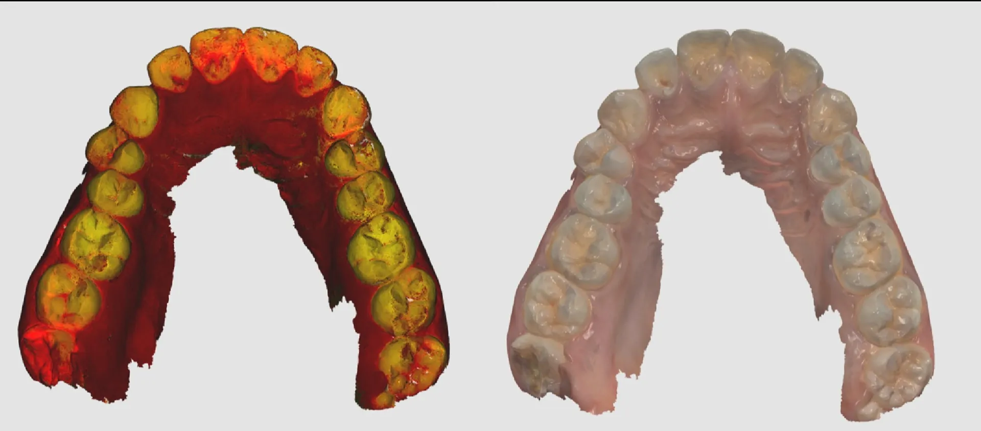 Caries Detection Dental Clinic in Madhura Nagar – Catching Problems Early