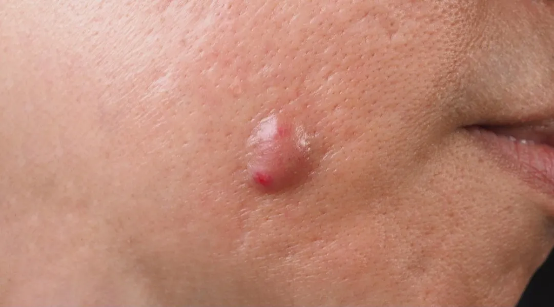 Sebaceous Cyst Surgery in Kolathur, Chennai - Clean Removal for Healthy Skin