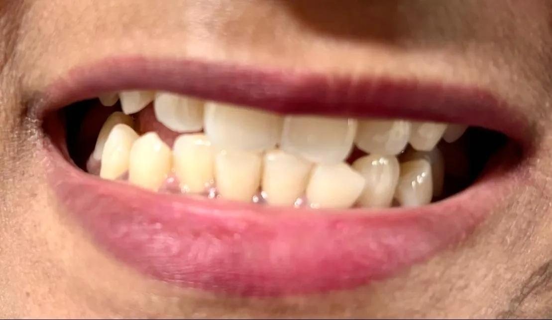 Best Teeth Whitening Options in Mumbai for a Brighter Smile