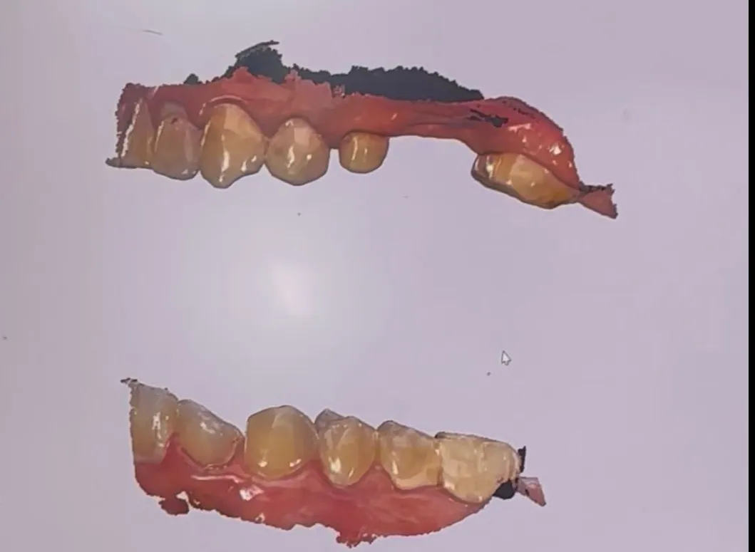 3D Scanning for Crowns and Implants – No More Gooey Impressions