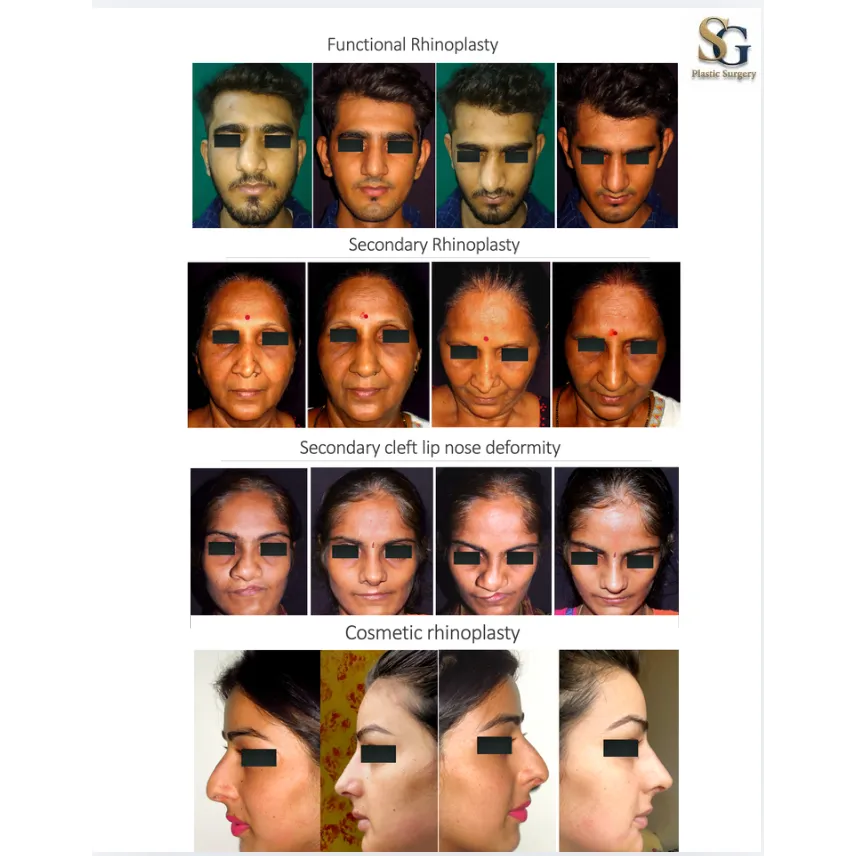 Best Rhinoplasty Surgeon in Mumbai - Cost , Procedure & Results