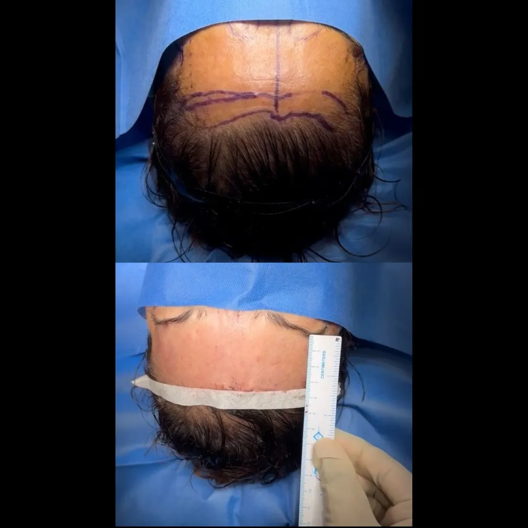 Brow Lift Surgery (Endoscopic Brow Lift) in Mumbai