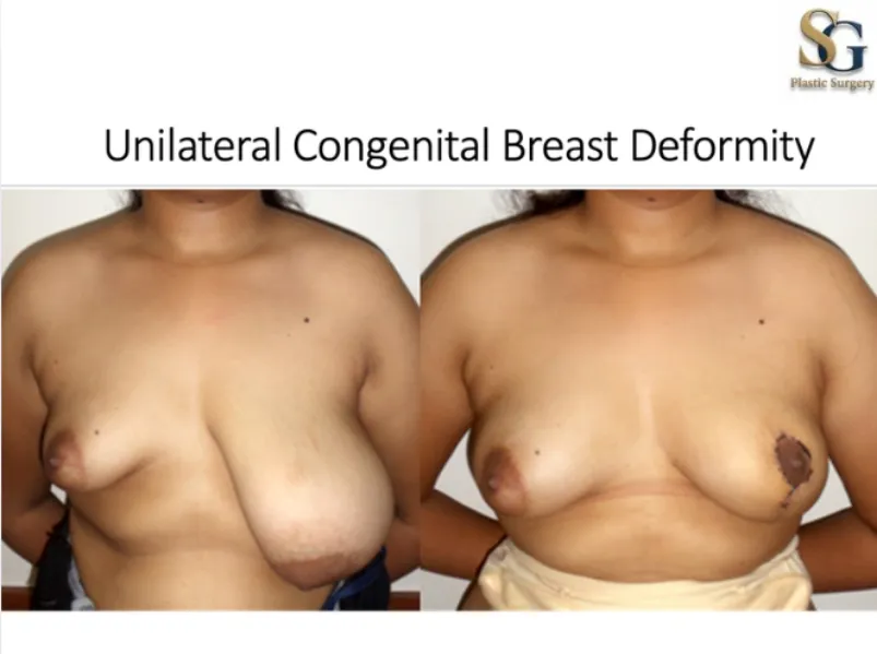 Breast Symmetry Surgery in Andheri,Versova, Lokhandwala | Balanced & Natural Results