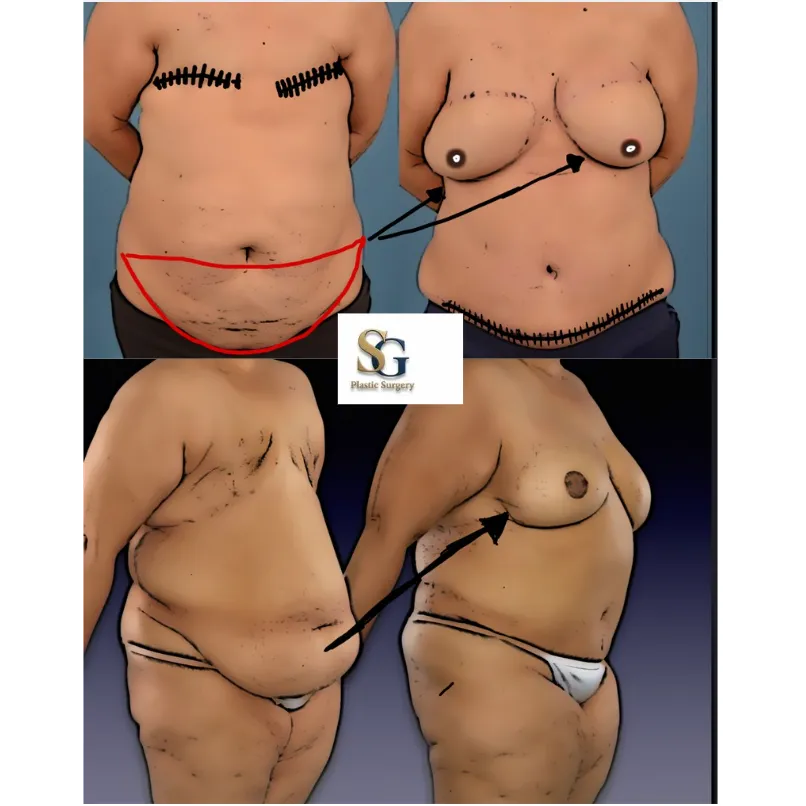 Post Mastectomy Breast Reconstruction Surgery in Mumbai- Implant & Flap Options