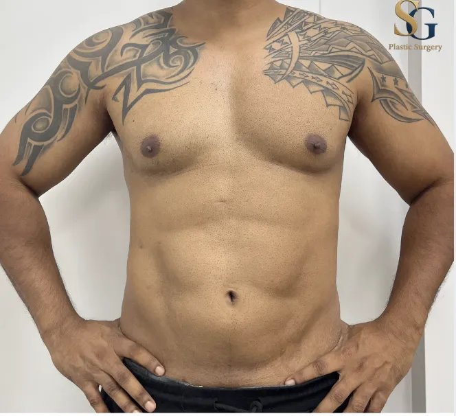 High-Definition Six Pack Creation Surgery in Andheri, Mumbai
