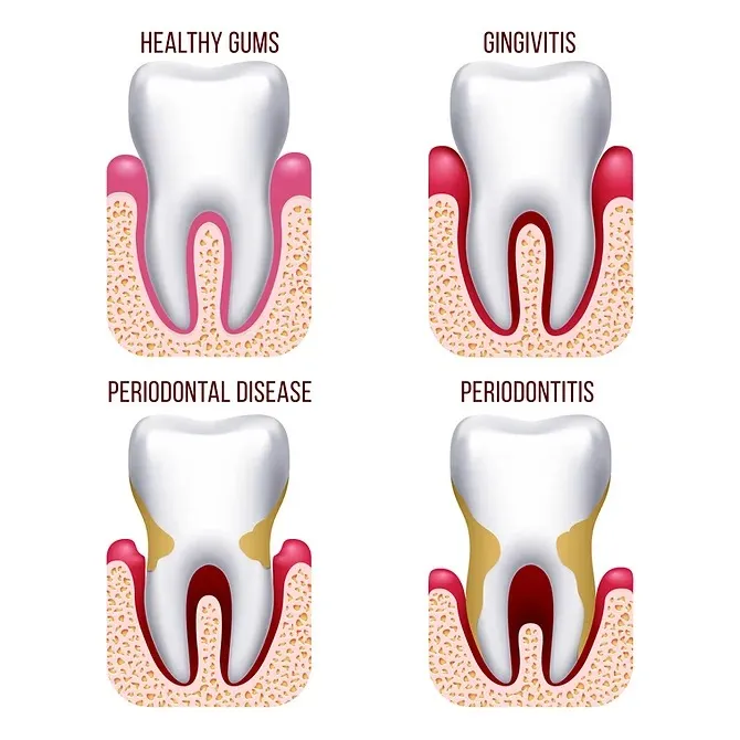 Gum Treatment in Noida Extension | P.D. Dental Clinic