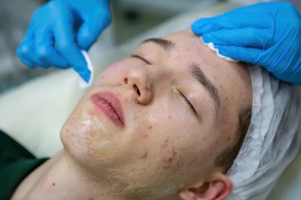 Treatments for Acne in Nagpur: Clear Your Skin with Professional Care