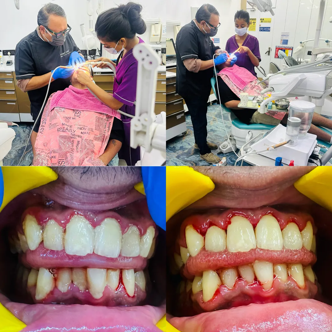 Why Gum Health Matters as much as your teeth especially for Smokers.
