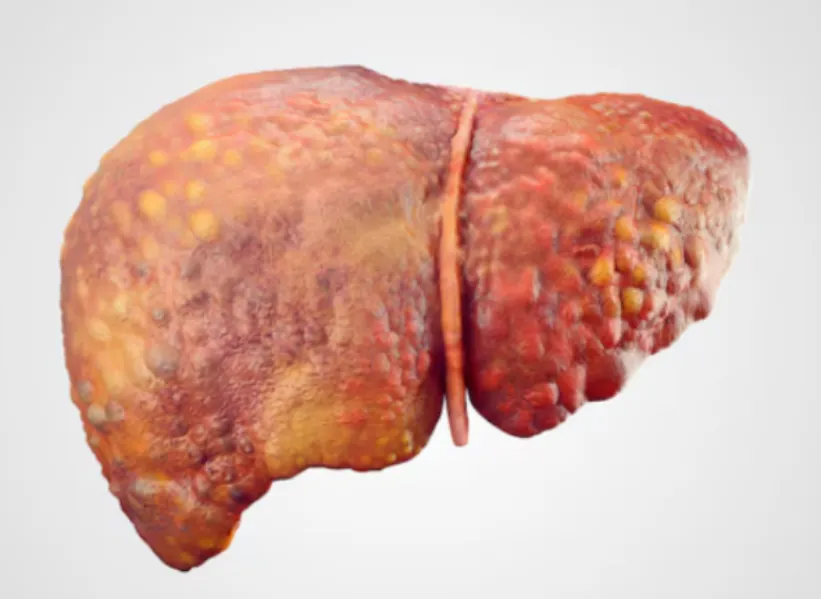 Fatty Liver Treatment in Mumbai – Early Care That Prevents Long-Term Damage