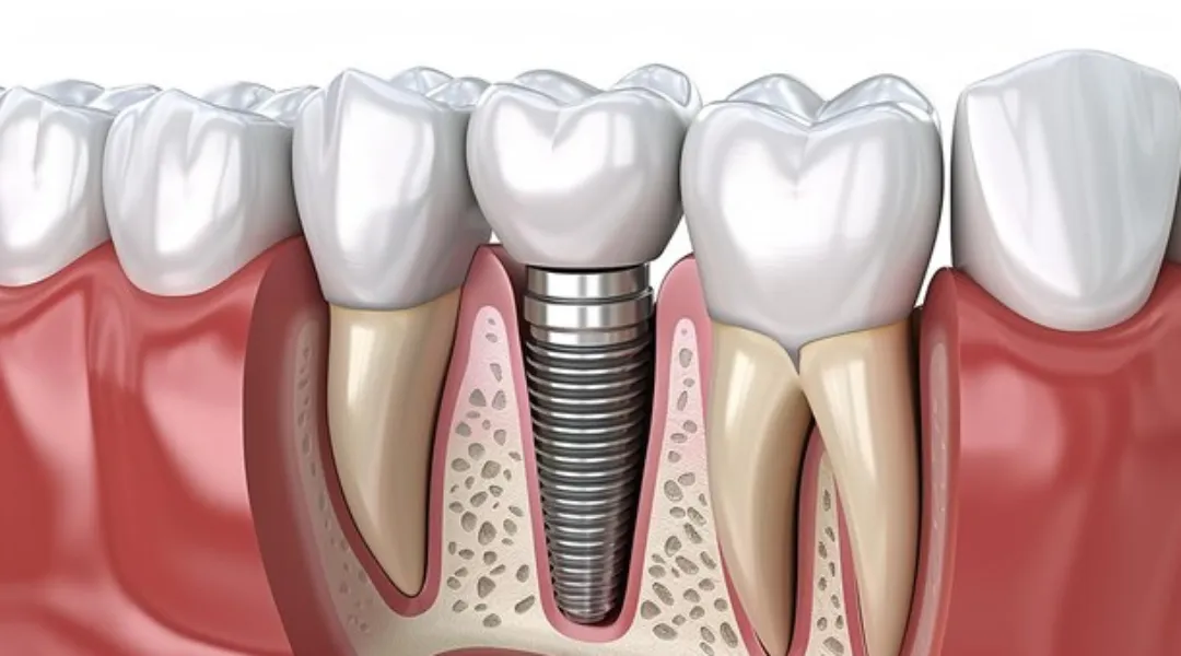 Full Mouth Implants in Dwarka – A Complete Smile Transformation