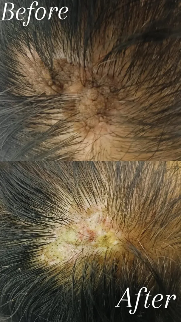 Dermoid Nevus Removal Treatment in vashi
