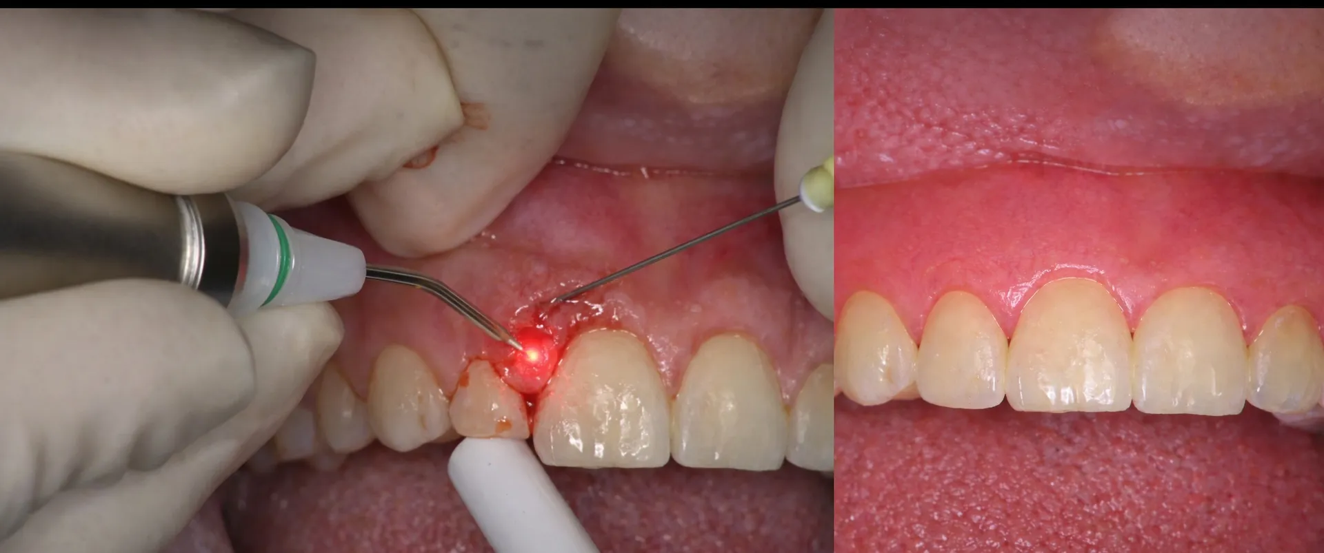 Laser Flap Surgery in Madhura Nagar – A Gentle Approach to Gum Health