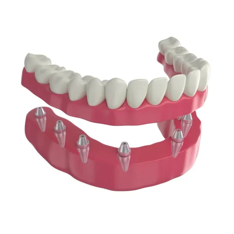 Implant Dentures in Dwarka – A Stable, Secure Solution for Missing Teeth