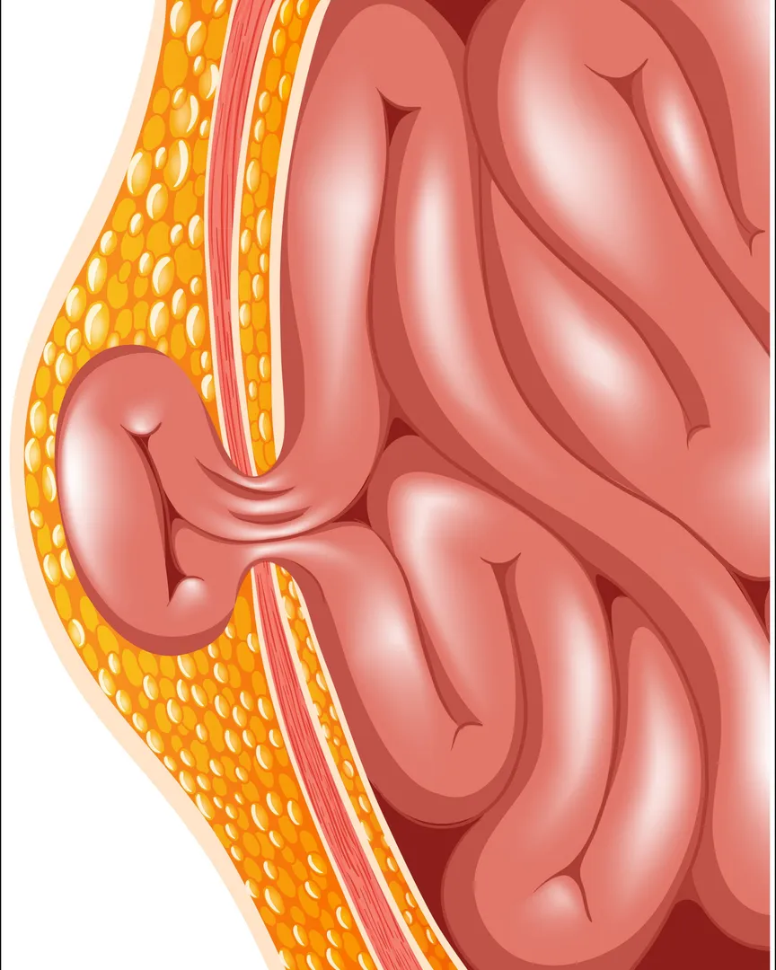 Hernia Surgeon in Kolathur, Chennai - Trusted Care for Long Term Relief