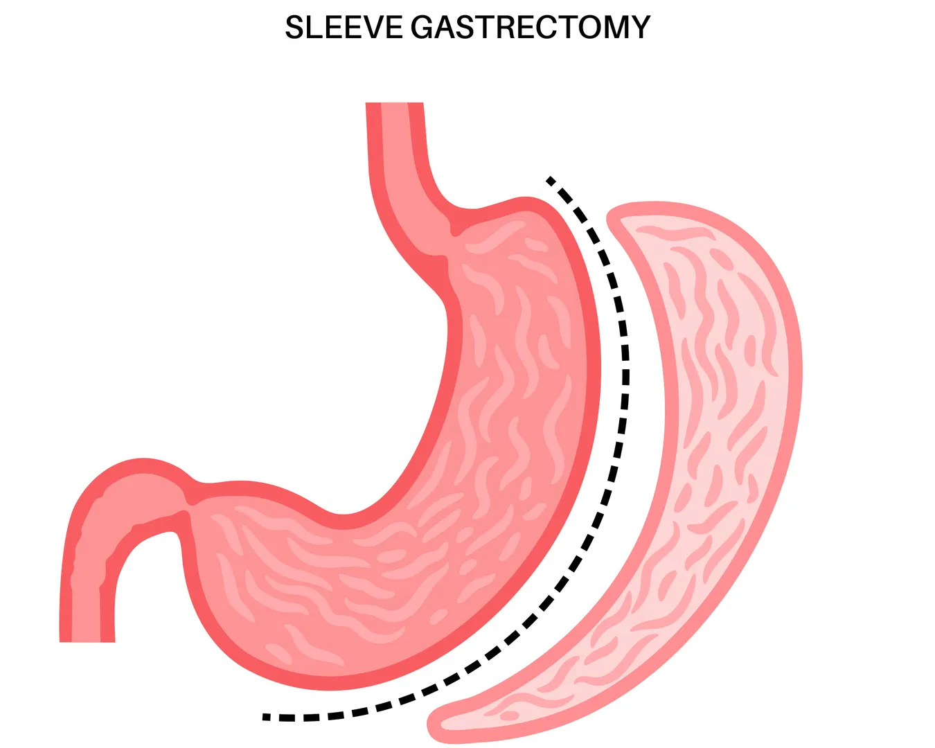 Laparoscopic Sleeve Gastrectomy in Mahalaxmi – A Proven Weight-Loss Solution for Lasting Change
