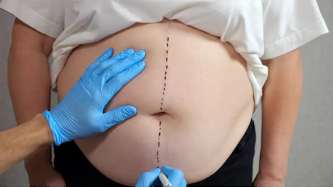 Mommy Makeover Surgery in Bengaluru – Comprehensive Post-Pregnancy Body Restoration