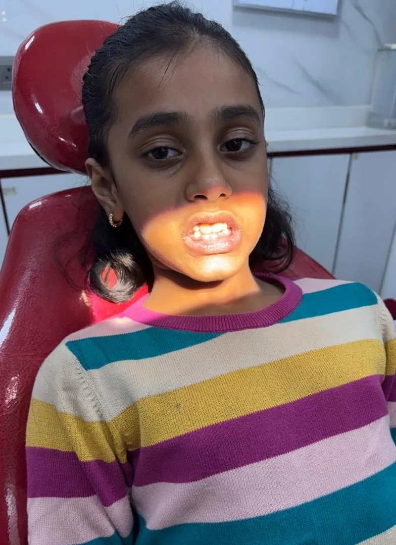 Fluoride Treatments for Kids – Are They Safe?