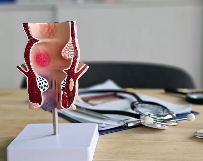 Fistula Treatment in Kolathur, Chennai - Complete Healing with Advanced Care