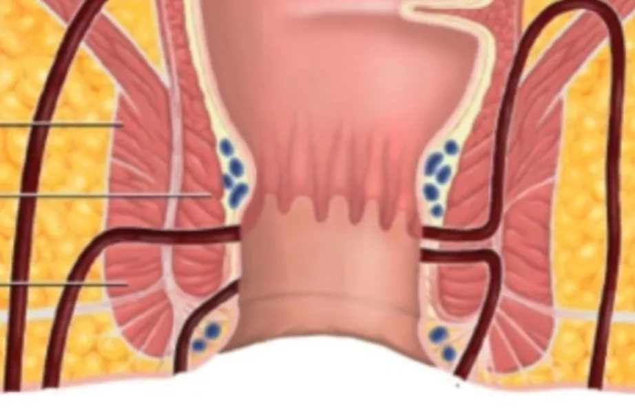 Fissure Surgery in Kolathur, Chennai - Gentle Surgical Care for Lasting Relief