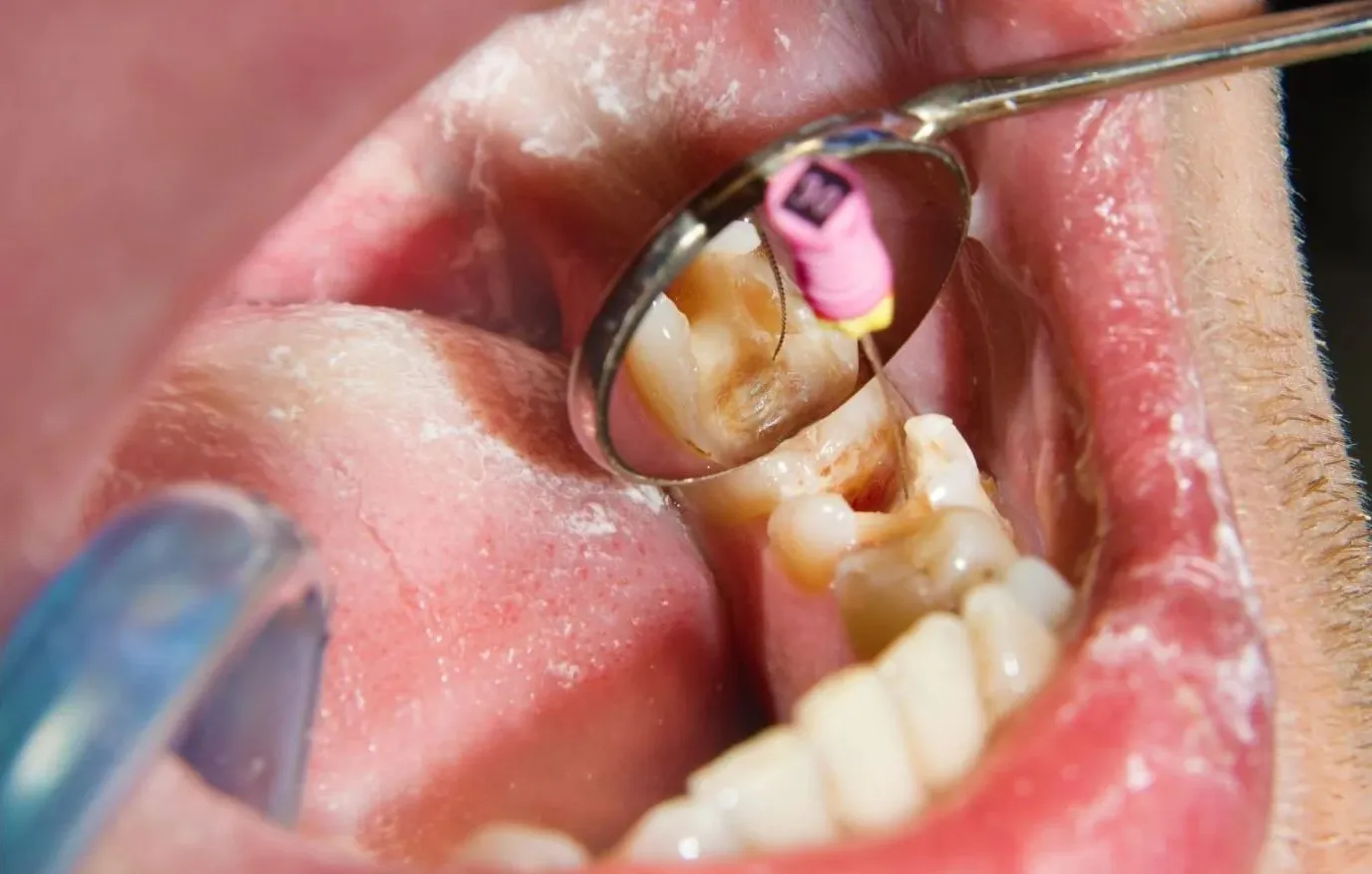Root Canal Treatment in Thane – Pain & Cost