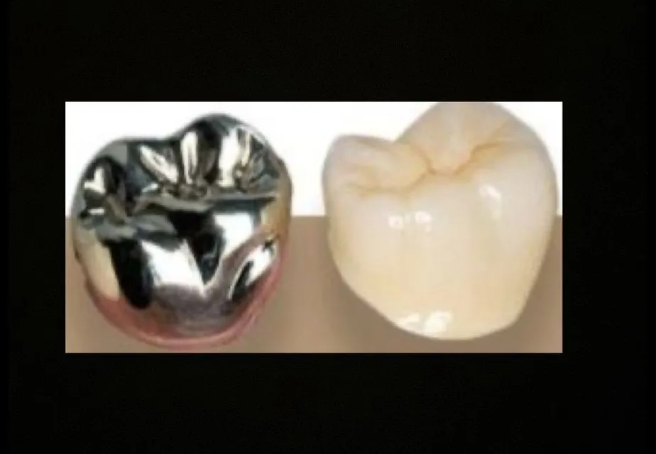Zirconia Crowns vs Metal Crowns