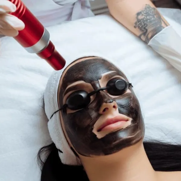 Carbon peel laser Treatment In Vashi