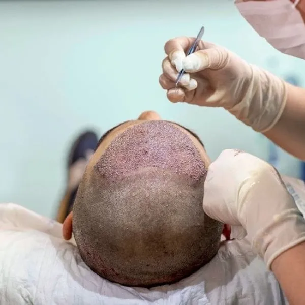 Hair Transplant Treatment In Vashi