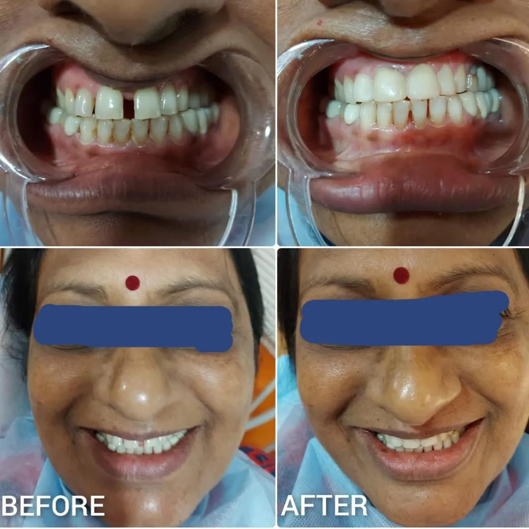 Bonded restorations for tooth space closure in Bangalore