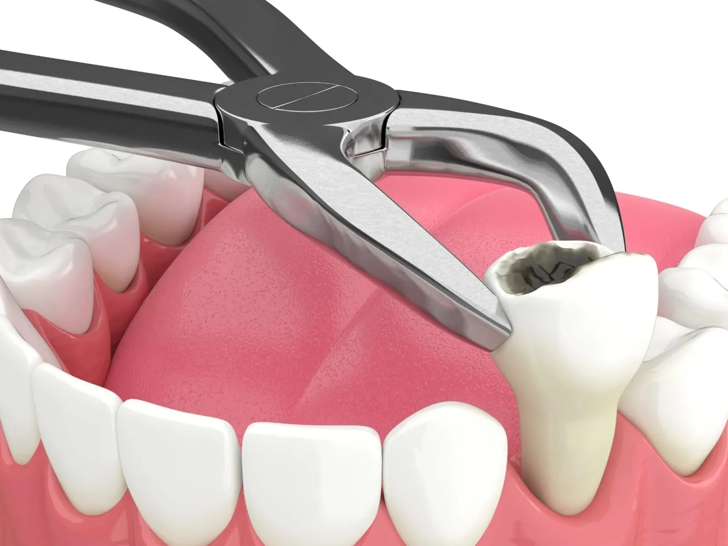 Extraction Treatment In Vashi