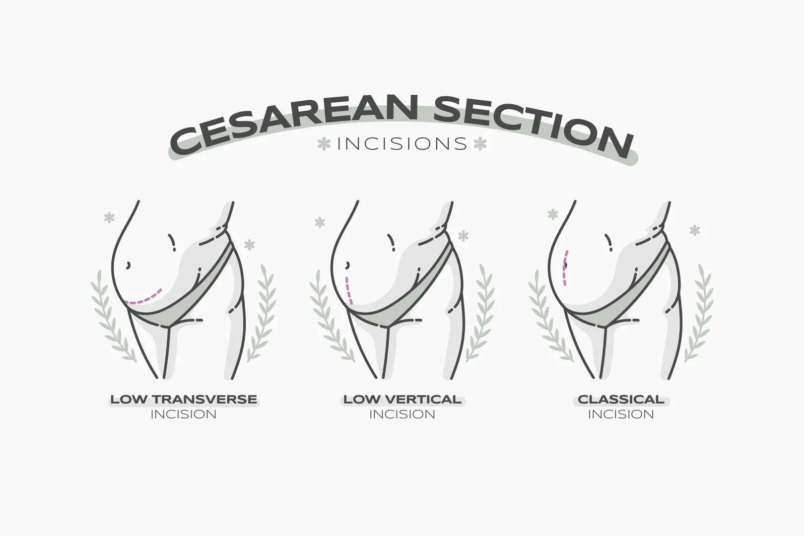 Caesarean Section Doctors in Thane – Prioritising Safety When Needed