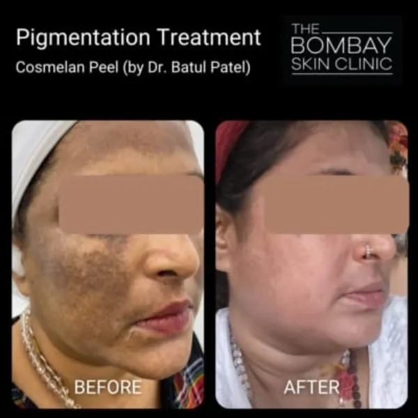 Cosmelan peel Treatment In Vashi