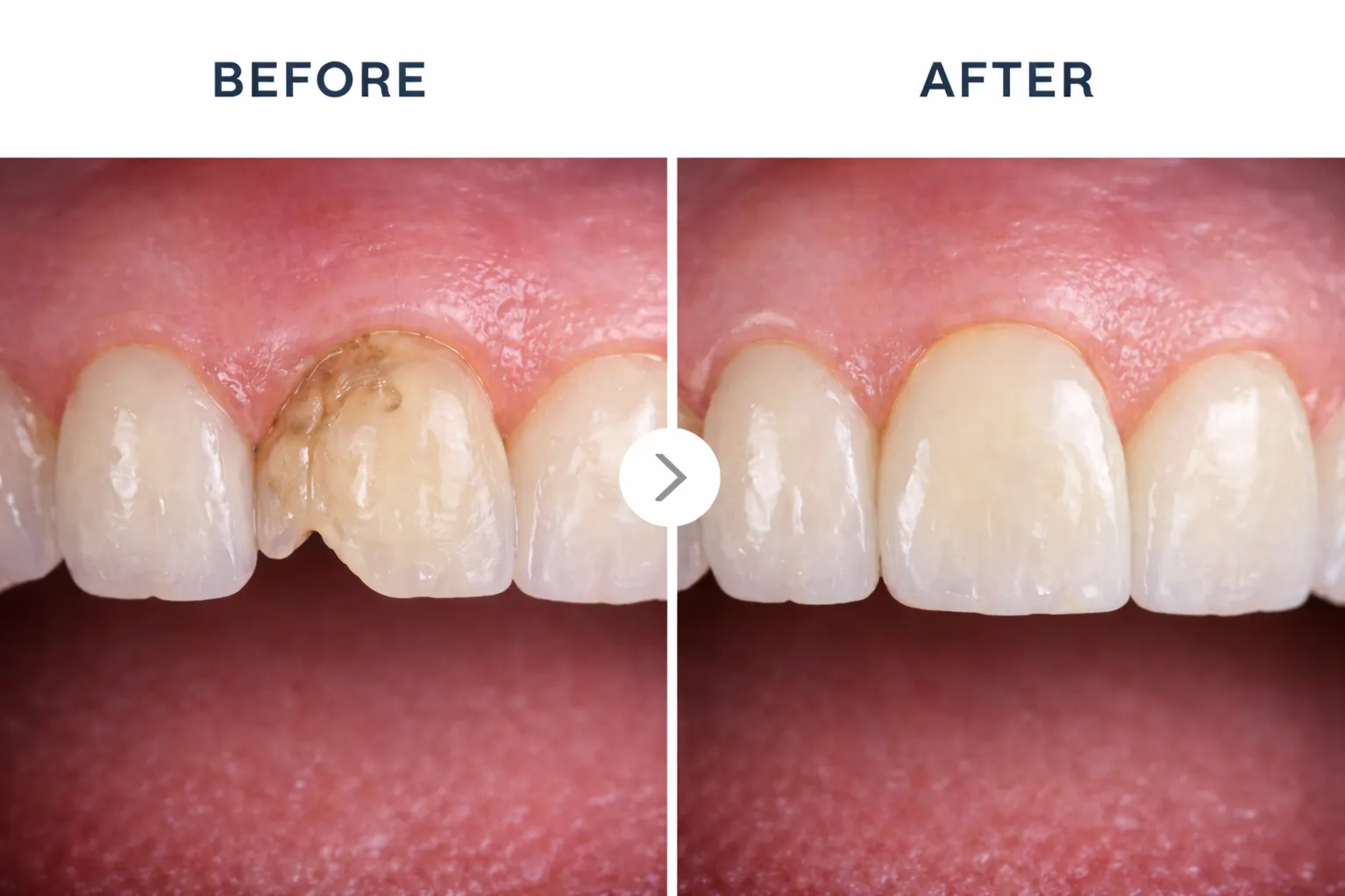 Lithium Disilicate (IPS Emax) Crowns in Madhura Nagar – Strength That Looks Natural