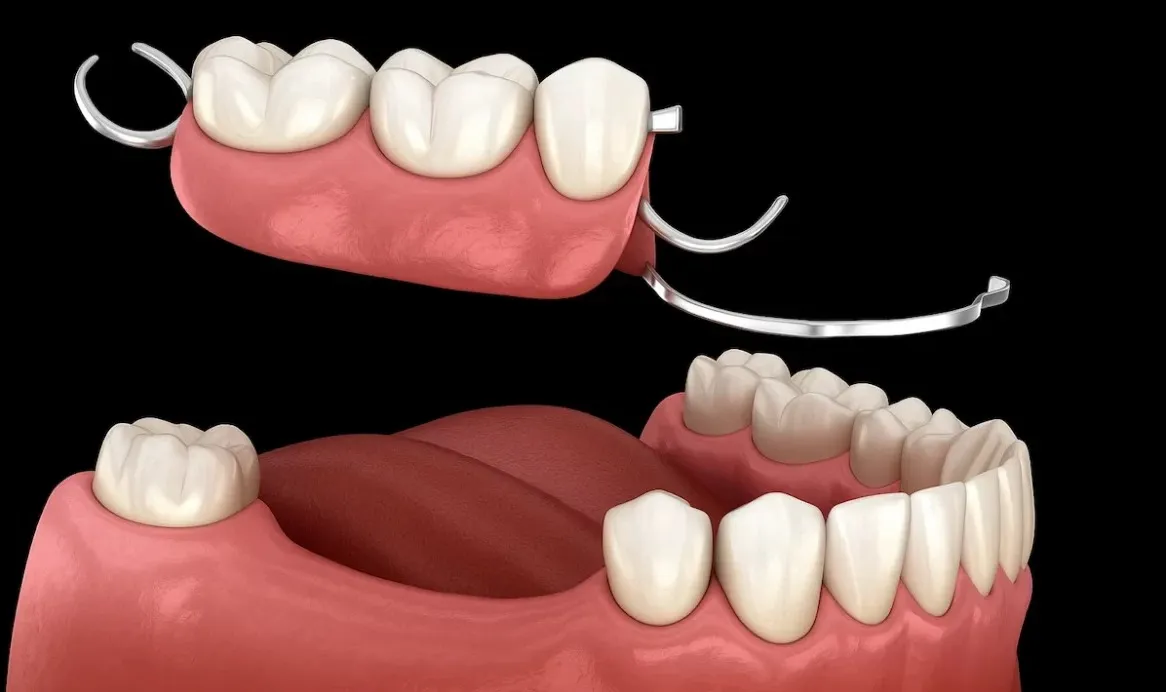 Fixed Teeth Replacement in Noida Extension | P.D.Dental clinic