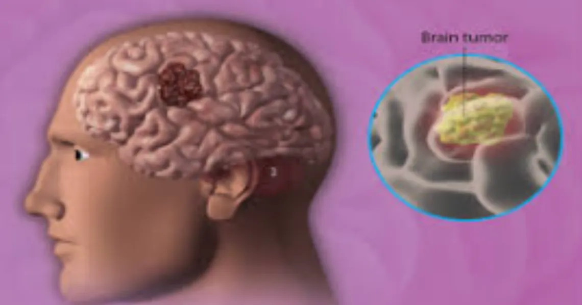 Brain Tumor Surgery in Gurugram – Precision and Compassion in Neurosurgery