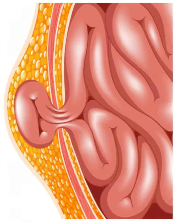 Laparoscopic Hernia Surgery Specialist in Sion – Modern Surgical Care with Minimal Downtime