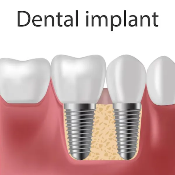 Low Cost Dental Implants in Dwarka – Affordable and Reliable Tooth Replacement