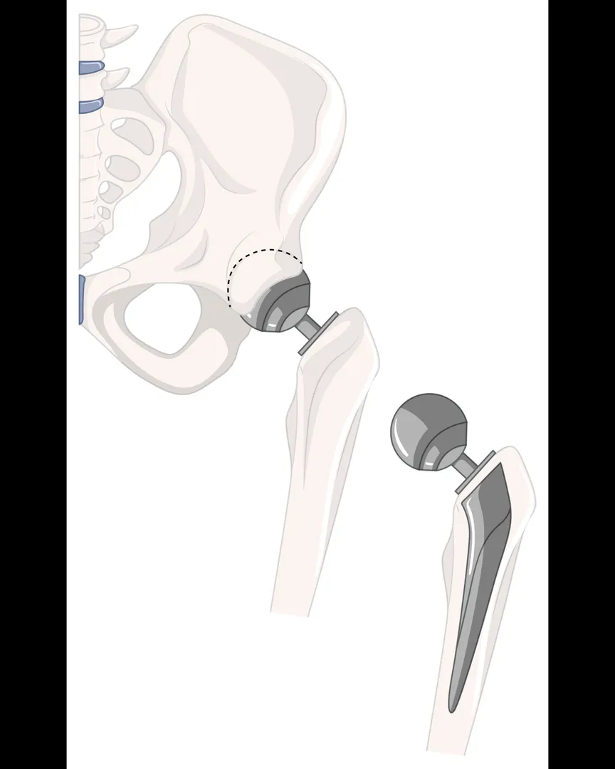 Total Hip Replacement in Nagarbhavi – Restoring Comfort and Balance