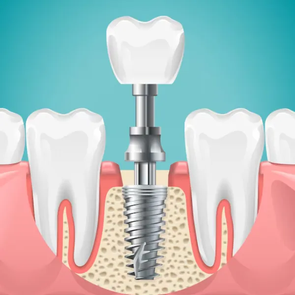 Same Day Tooth Implant Treatment in Delhi – Immediate Smile Restoration