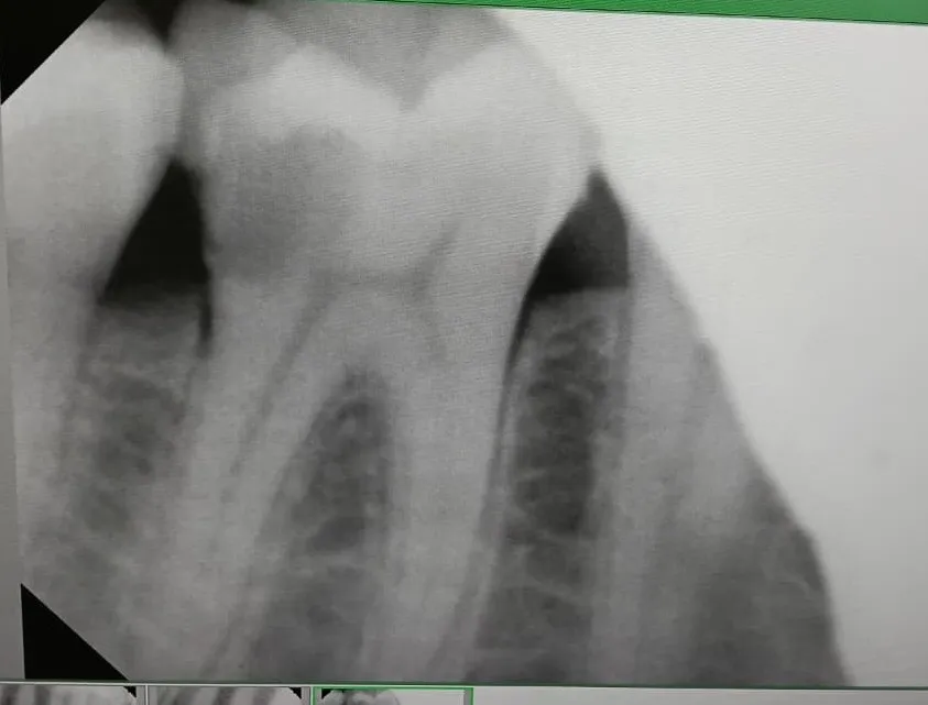How Long Does Root Canal Treatment Take? Timeline Explained by Dentists in Mulund West Mumbai