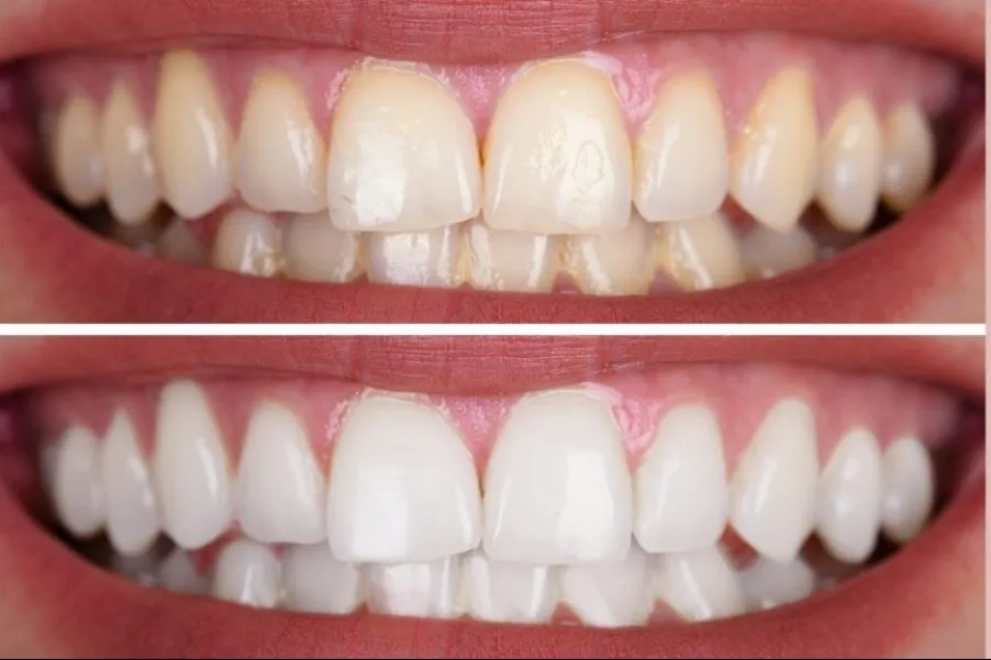 Best Dentist for Teeth Whitening in Thane (Nitin Company Area): What to Expect During Treatment