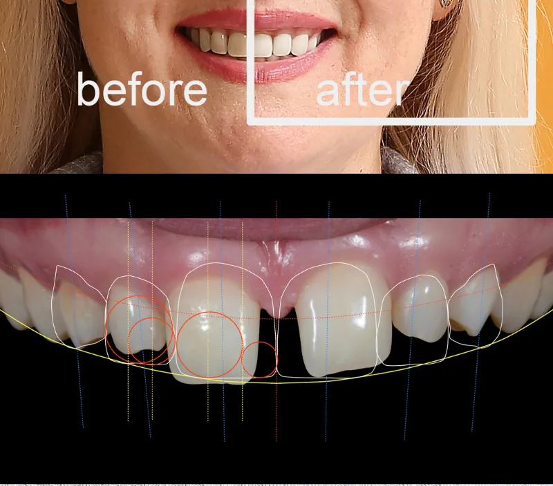 Best Dentist for Smile Makeover in Mulund West Mumbai: What to Expect During Treatment
