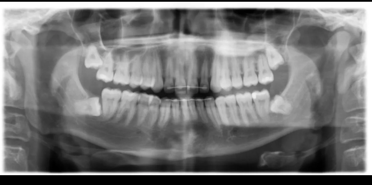 Best Dentist for Wisdom Tooth Removal in Thane (Nitin Company Area): What to Expect During Treatment