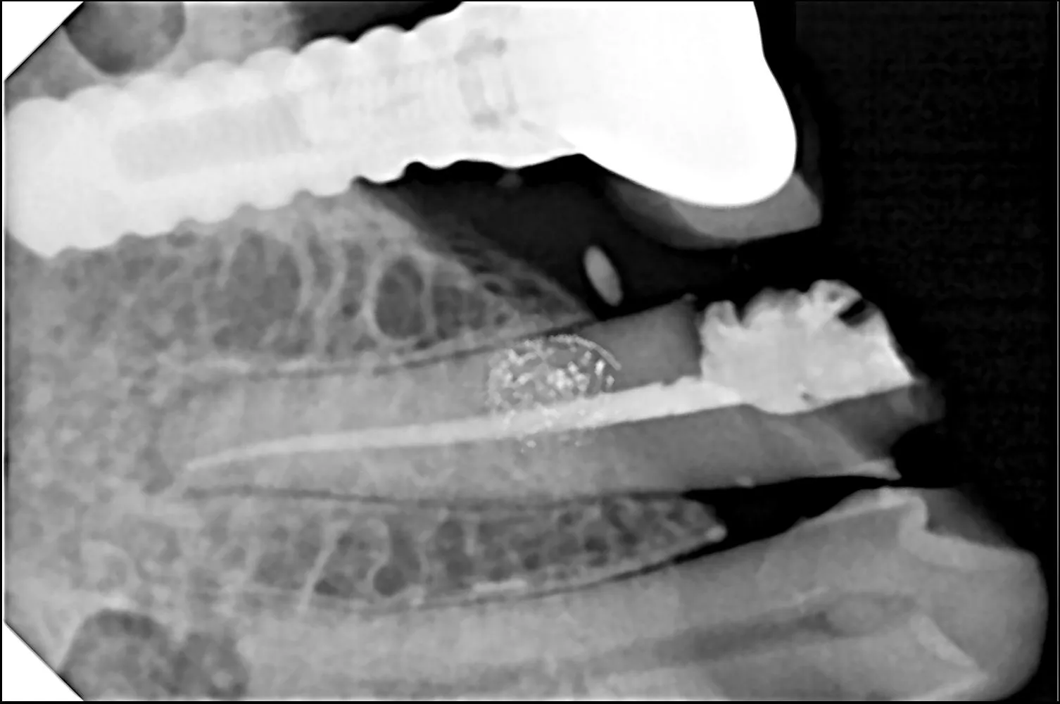 Root Canal Treatment in Thane (Nitin Company Area): Cost, Procedure & Recovery Time Explained