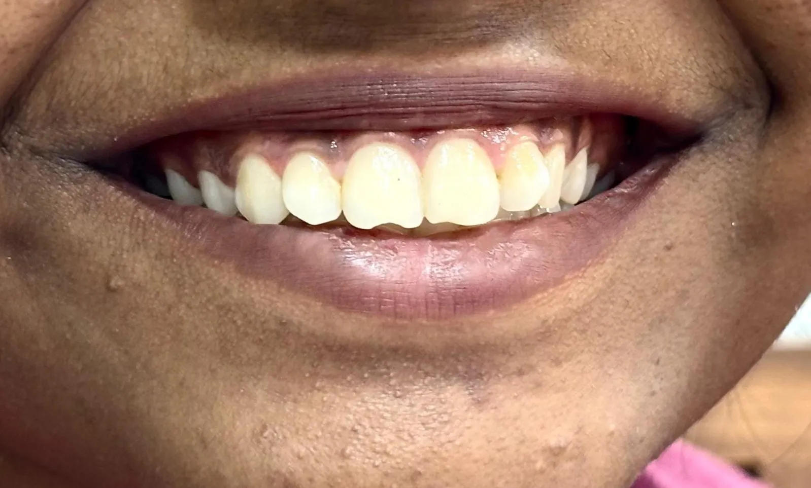 How Much Does Teeth Whitening Cost in Thane (Nitin Company Area)? A Complete Patient Guide