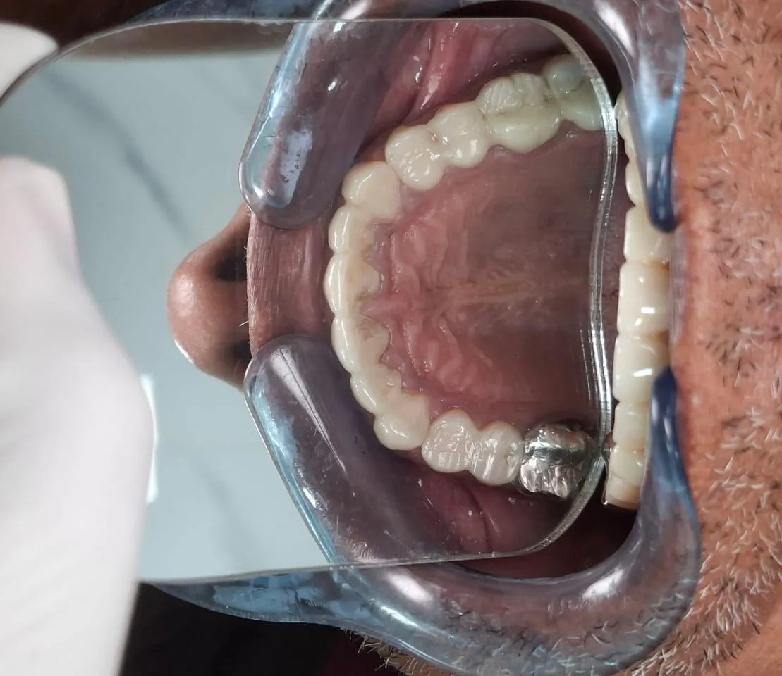 How Much Does Dental Crowns Cost in Thane (Nitin Company Area)? A Complete Patient Guide