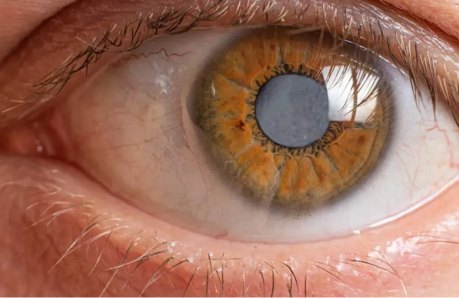 Cataract Evaluation and Surgical Services in Grant Road