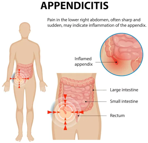 Appendicitis Treatment in Goregaon – Recognizing the Right Time for Care