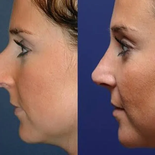 Rhinoplasty in Delhi